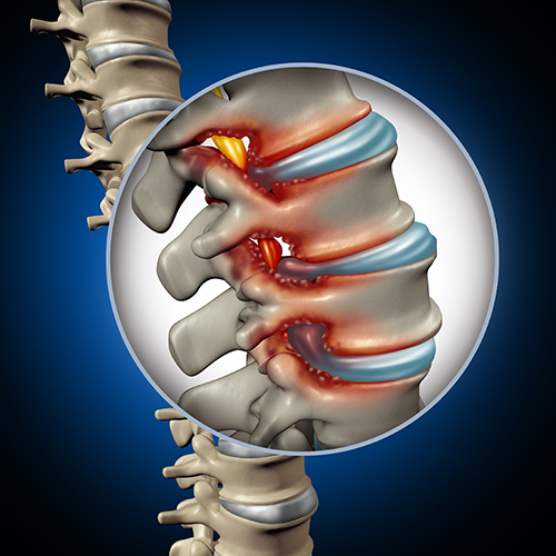 Chiropractic Family Wellness Center - Spinal Stenosis